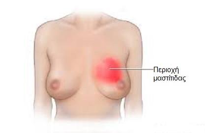 Συνήθη Προβλήματα - Μαστίτιδα Συμπτώματα: 1. Γενικευμένη κακουχία 2. Πυρετός > 38,5 0 C 3. Ρίγος & Πονοκέφαλος 4. Ερυθρότητα & Πόνος στο στήθος & στην θηλή ή στην θηλαία άλω 5.