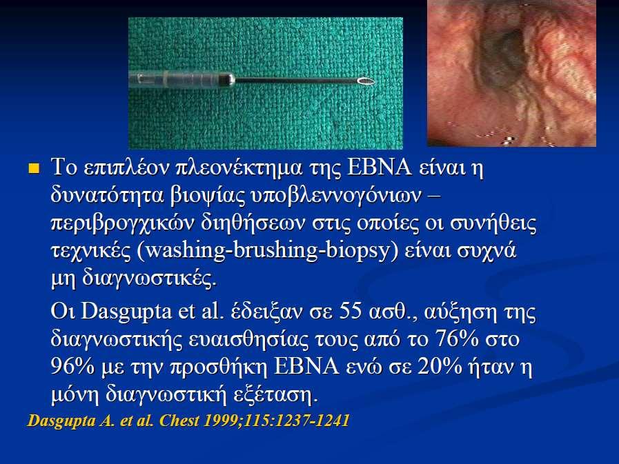 Endobrochial-Τransbronchial Needle Aspiration ((E)-BNA) Δυνατότητα λήψης βιοψιών από υποβλεννογόνιες διηθήσεις και περιβρογχικές μάζες