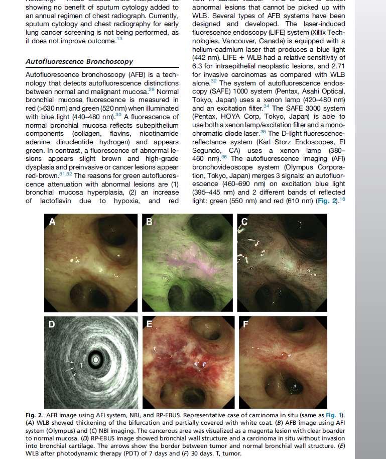 Πρώιμη διάγνωση καρκίνου του πνεύμονα Autofluorescence bronchoscopy (AFB) AFB: Eυαισθησία: 44%-82%,