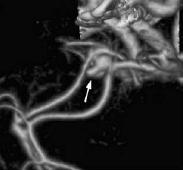 Αξονική Αγγειογραφία, τεχνική VRT: Ανεύρυσμα της προσθίας αναστομωτικής αρτηρίας (λευκό βέλος).