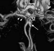 Ανεύρυσμα του διχασμού της δεξιάς μέσης εγκεφαλικής αρτηρίας. Ψηφιακή Αφαιρετική Αγγειογραφία (Αριστερά) και Αξονική Αγγειογραφία, τεχνική VRT (Δεξιά). ΙΙΙ.