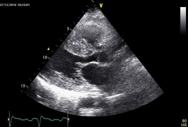 Υπερηχοκαρδιογράφημα ΜΚΔ: 22 mmhg