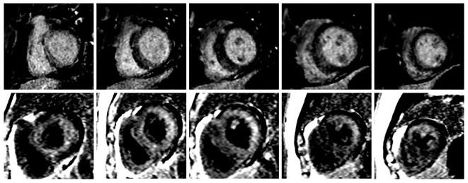 could early stage of amyloidosisbegin with cardiac hypertrophy without significant amyloiddeposition elsewhere and thus could be confused