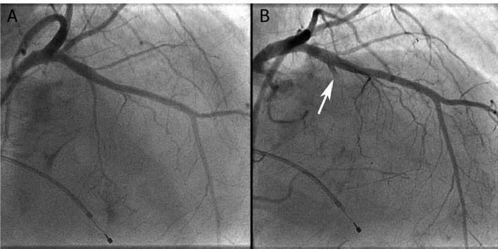 Septal alcohol ablation is associated with a higher risk of AV block, requiring permanent pacemaker implantation and larger residual LV