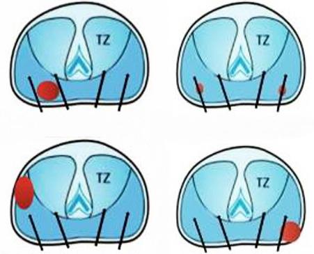 Εξέλιξη της βιοψίας προστάτου - MRI ΓΙΑΤΙ MRI?