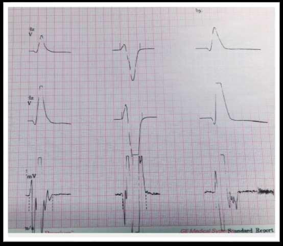 SAECG Total QRS duration:130ms Duration of