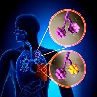 Άσθμα ως συνοσηρότητα στη ΧΑΠ ειδική αντιμετώπιση; Γεώργιος Χειλάς Πνευμονολόγος - Επιμελητής Β