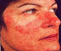 Είναι σχετικά συχνή κατάσταση στις νεαρές γυναίκες, αποτέλεσμα των χειρισμών των βλαβών της ακμής, (πίεση, σύνθλιψη, ξύσιμο κλπ.). (11) 2.3.3. ΡΟΔΟΧΡΟΥΣ ΑΚΜΗ (acne rosacea) Εικόνα 3.
