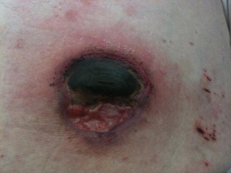 with primary cutaneous peripheral