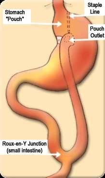 Roux-en-Y Gastric Bypass 15-25 ml γαστρικός θύλακος με 1 cm «έξοδο»