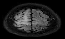 leukoencephalopathy