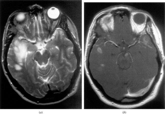 ADEM: Acute disseminated encephalomyelitis The imaging findings in this