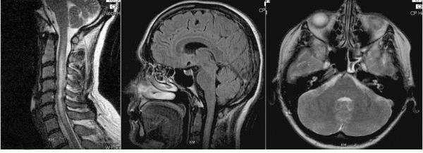 MRI - NMO Neuromyelitis optica: - Primary CNS demyelinating disease - Transverse myelitis and optic neuritis - At least 2 of