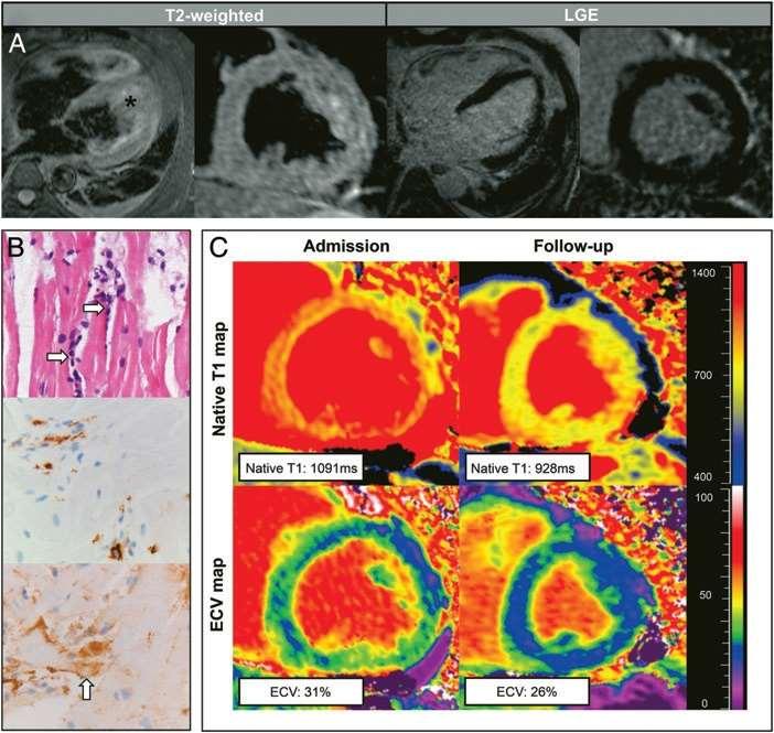 T1-Mapping in a Case of Acute Biopsy-Proven Myocarditis with an Apparently