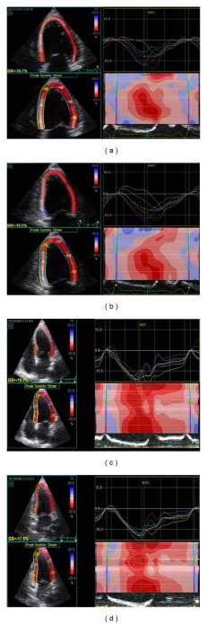 Patients with Acute Myocarditis and