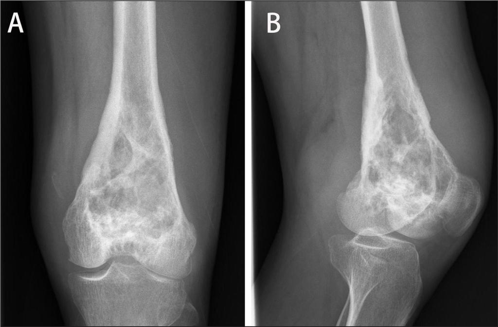 Ινοσάρκωμα (Fibrosarcoma) ινοσάρκωμα είναι κακοήθης νεοπλασία, η οποία προέρχεται από μεσεγχυματικά κύτταρα Προσβάλλει τόσο τά μαλακά