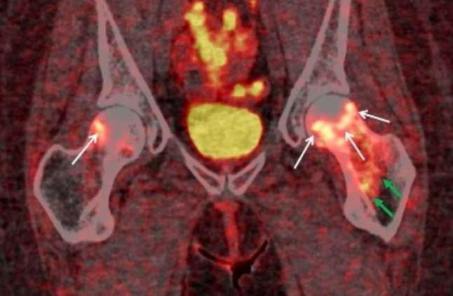 Ga-DOTATATE PET/CT