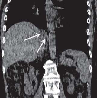 PET/CT 18 F-FDG