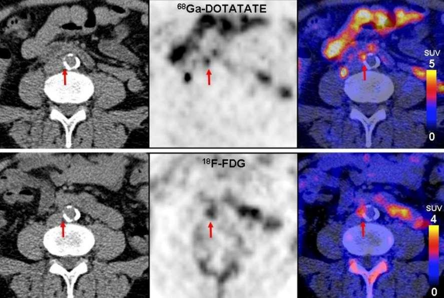 68 Ga-DOTATATE vs 18 F-FDG PET/CT 61-χρονος άνδρας, με υπέρταση, και ιστορικό