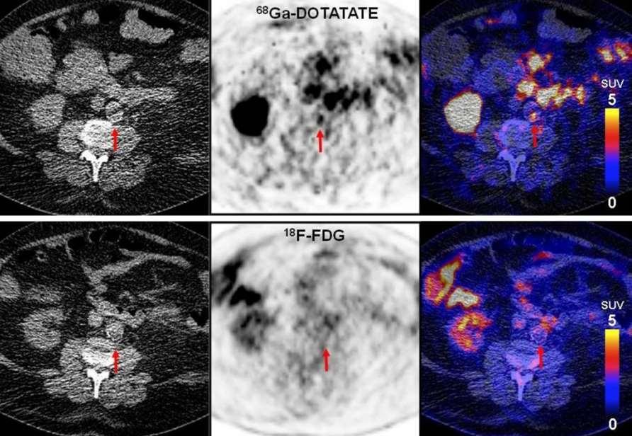 68 Ga-DOTATATE vs 18 F-FDG PET/CT 73-χρονος άνδρας, καπνιστής με υπέρταση, και