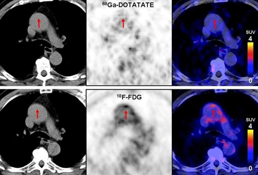 68 Ga-DOTATATE vs 18 F-FDG PET/CT 77-χρονος άνδρας, καπνιστής με υπέρταση, υπερχολιστερολαιμία, ιστορικό