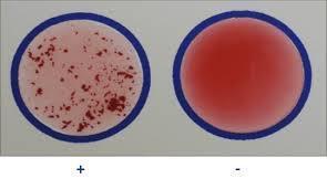ΣΥΓΚΟΛΛΗΤΙΝΟΑΝΤΙΔΡΑΣΗ Ένωση ενός σωματιδιακού Ag με το ομόλογο Ab: σχηματισμός κροκίδων Ag στην επιφάνεια κυττάρων (ερυθρά αιμοσφαίρια, μικρόβια) ΑΜΕΣΗ ΣΥΓΚΟΛΛΗΣΗ διαλυτά Ag προσροφημένα στην
