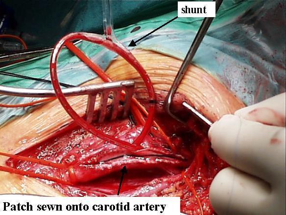 Ενδαρτηρεκτομή καρωτίδας με τοποθέτηση