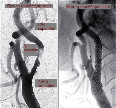Καρωτίδα αρτηρία πριν και μετά