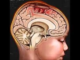 Ιδιαιτερότητες στην κάκωση κεφαλής - αυχένα Μεγαλύτερη ευαισθησία του παιδικού εγκεφάλου στην υποξία και υποογκαιμία Η μη έγκαιρη