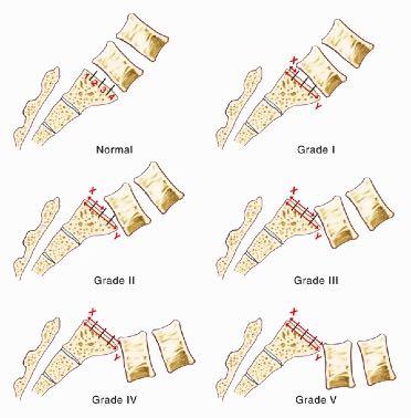 Grade >50% 1ου βαθμού 1-25% 2ου >> 26-50%