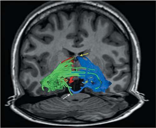 three-dimensional reconstruction of the fiber tracts crossing the amygdala and the hippocampus overlayed on a coronal T1-weighted MR image.