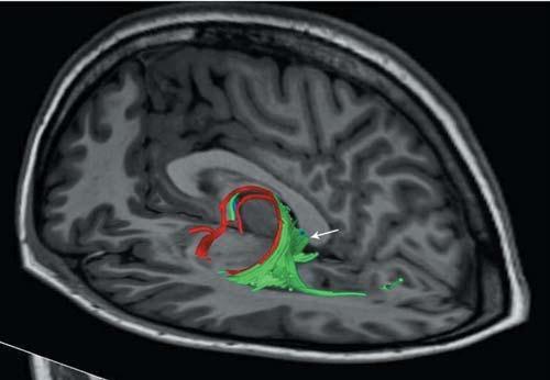 Three-dimensional reconstruction of the fiber tracts crossing the amygdala and the hippocampus overlayed on a sagittal T1-weighted MR image.