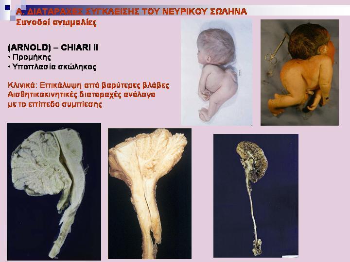 H ανωμαλία Chiari (Arnold-Chiari II) συνοδεύει συχνά τις διαταραχές σύγκλεισης του νευρικού σωλήνα.