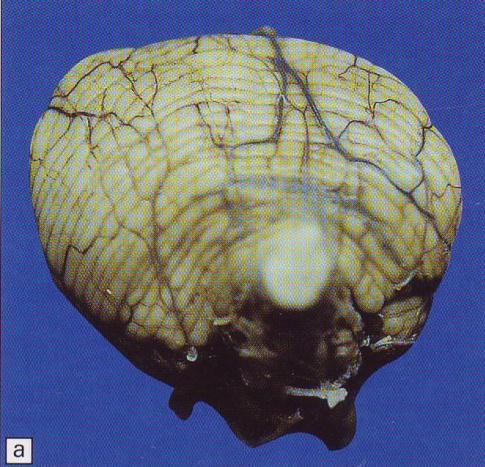 molar tooth sign σημείο «γομφί