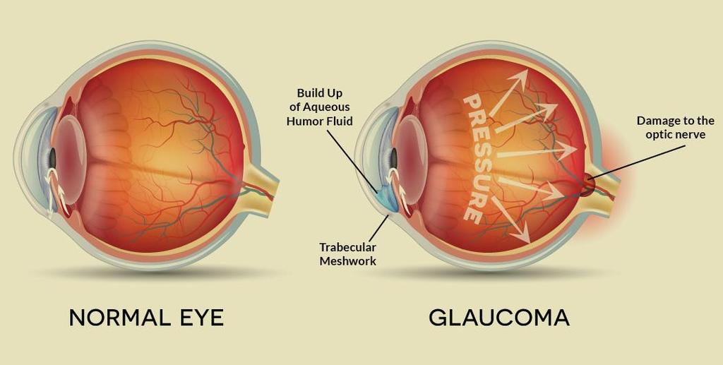 Cataract and ocular hypertension in children on