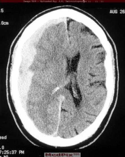 Εικόνα 1-7 ενδοεγκεφαλικό αιμάτωμα σε αξονική τομογραφία (Δαβανέλος, 2013) Η αυξημένη ενδοκρανιακή πίεση προκαλεί βλάβη στην εγκεφαλική αιμάτωση.
