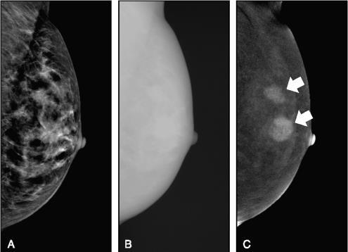 Contrast Enhanced Spectral Mammography (CESM) Low kv High kv Combined image image image Χρησιμοποιείται επικουρικά.