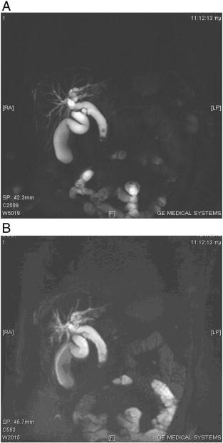 Lavdas E, Tsougos I, Vassiou KG. How reliable is MRCP with an SS-FSE sequence at 3.