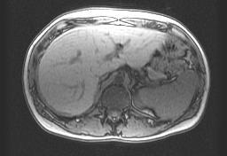 R=1 scan