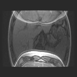 R=2 scan