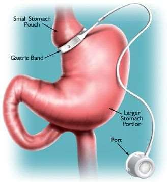 Γαστρικός δακτύλιος (Αdjustable Gastric Banding, AGB) Η τοποθέτηση ενός δακτυλίου στο αρχικό τμήμα του στομάχου και η