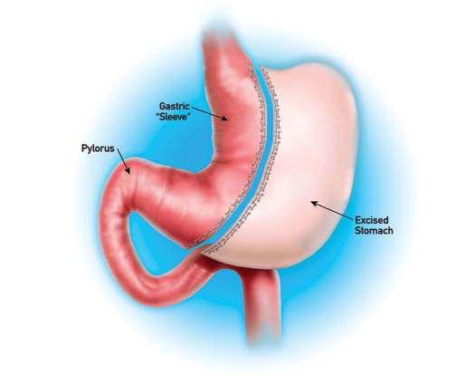 Επιμήκης γαστρεκτομή (sleeve gastrectomy) Ο θόλος του στομάχου αφαιρείται δίνοντας στο στομάχι