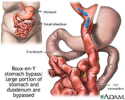 Roux-en Y γαστρική παράκαμψη (RYGB) Σε αυτήν την επέμβαση το στομάχι χωρίζεται σε μία μικρή γαστρική σακούλα