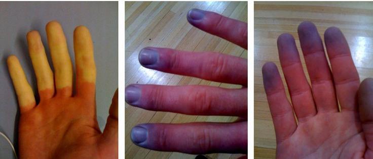 Στο φαινόμενο Raynaud η κυάνωση εμφανίζεται στη φάση