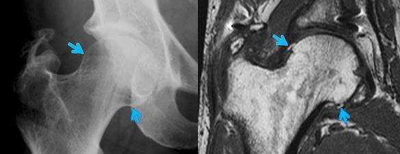 MRI Ακτινογραφία η A/A έχει υψηλή ειδικότητα (76-90%) χαμηλή ευαισθησία (44-78%) Χαμηλή ειδικότητα (48-52%) Διάχυτη καταστροφή του χόνδρου Μηριαία οστεόφυτα Υπαρθρικές κύστεις κοτύλης Οστική φθορά