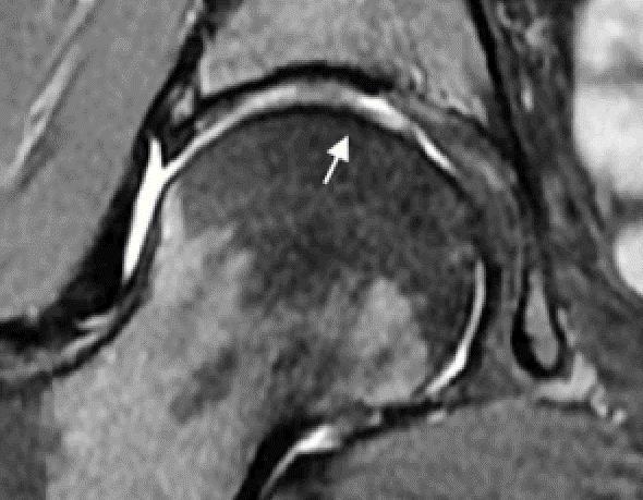 MRI κατάταξη επιχ.χόνδρος β5 1. Απώλεια αρθρ. χόνδρου.0-2 2.