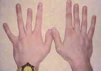 Διαταραχή Pelger-Huët Ασθενής με PHA ο οποίος έχει κοντύτερα το τρίτο και το πέμπτο metacarpals στο αριστερό του χέρι και από το