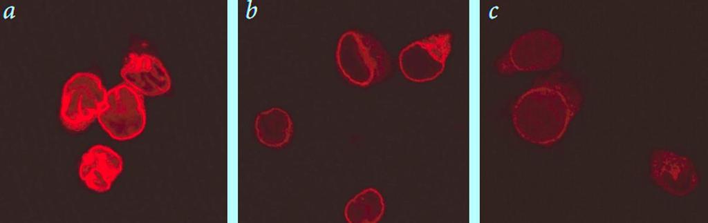 Έκφραση του LBR με χρήση αντισώματος σε λεμφοκύτταρα ενός: (a) φυσιολογικού ατόμου, (b) ετεροζυγώτη, και (c) ομοζυγώτη που