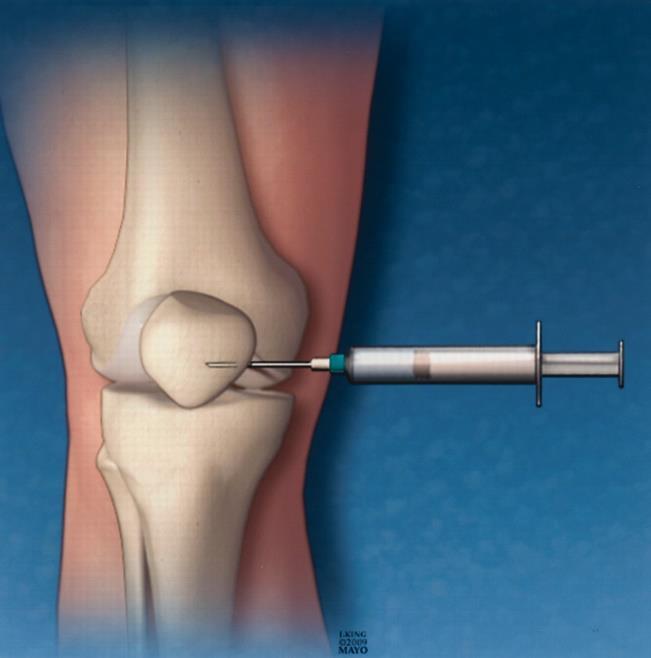 Κλινική εξέταση-εργαστηριακός έλεγχος Ύδραρθρο δεξιού γόνατος Χωρίς εικόνα ενεργού αρθρίτιδας πλην του γόνατος Παρακέντηση ΔΕ γόνατος και αφαίρεση