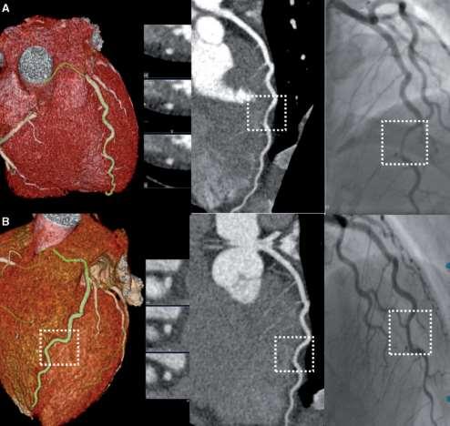 ) scad/screening & απεικόνιση στο follow-up Liang JJ, J Cardiovasc Comput